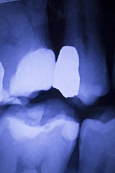 Dentysta dentystyczny zęby xray — Zdjęcie stockowe