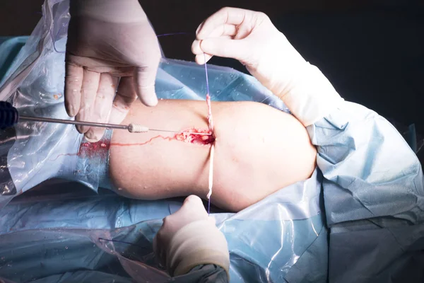 外科手术膝盖手术 — 图库照片