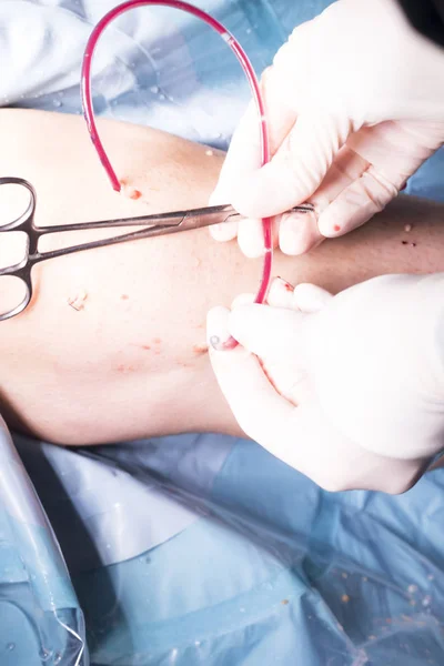 Χειρουργική επέμβαση στο γόνατο χειρουργική επέμβαση — Φωτογραφία Αρχείου