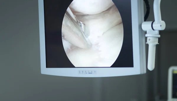 Tela de cirurgia de artroscopia — Fotografia de Stock