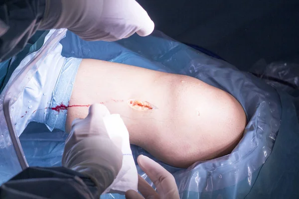 Surgical operation knee surgery — Stock Photo, Image