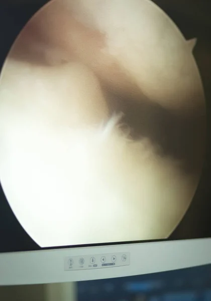 関節鏡手術画面 — ストック写真