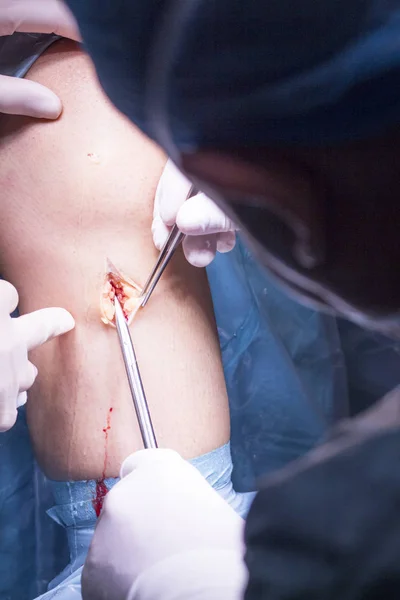 Operação cirúrgica cirurgia do joelho — Fotografia de Stock