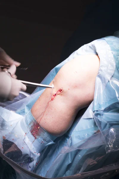 Cirugía quirúrgica Cirugía de rodilla — Foto de Stock