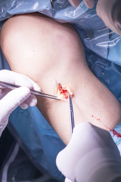 외과 수술 무릎 수술 — 스톡 사진