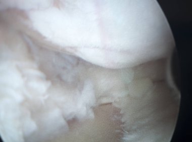 Artroskopi ameliyatı ekran