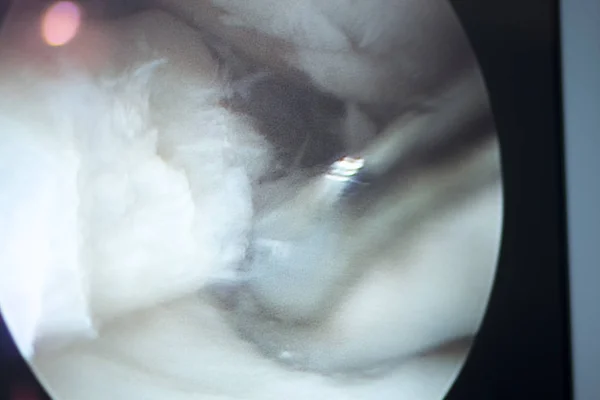 Artroskopi ameliyatı ekran — Stok fotoğraf