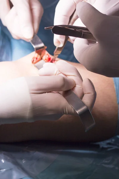 Chirurgická operace kolenního kloubu — Stock fotografie