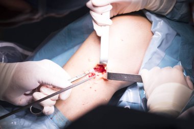 Cerrahi operasyon diz cerrahisi