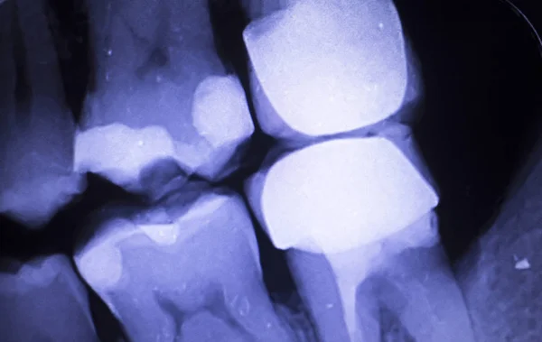 Ząb wypełnienia stomatologiczne xray — Zdjęcie stockowe