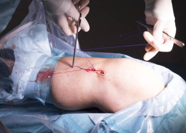 Cerrahi operasyon diz cerrahisi