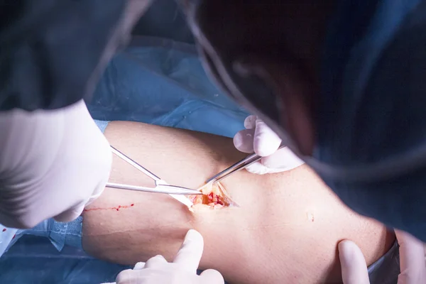 Хирургическая операция на колене — стоковое фото