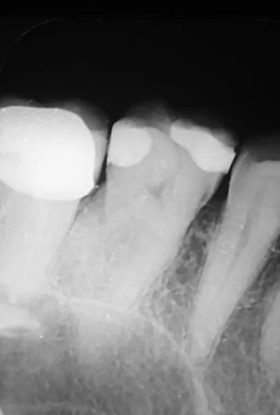 Tooth filling dental xray — Stock Photo, Image