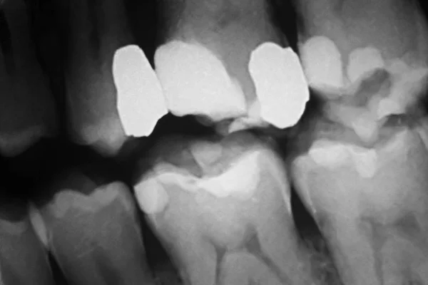 Ząb wypełnienia stomatologiczne xray — Zdjęcie stockowe