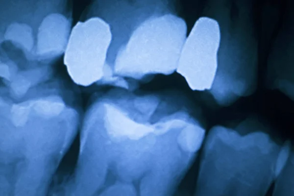 Δόντι πλήρωσης οδοντιατρική xray — Φωτογραφία Αρχείου