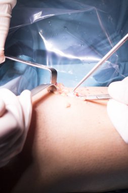 Cerrahi operasyon diz cerrahisi