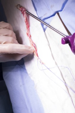 Diz tendon bağ ameliyatı