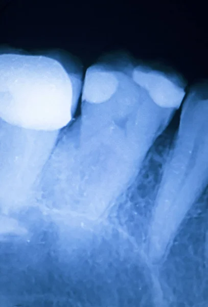 Δόντι πλήρωσης οδοντιατρική xray — Φωτογραφία Αρχείου