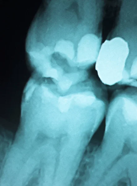 Llenado dental radiografía dental — Foto de Stock