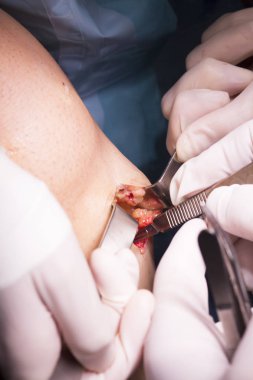 Cerrahi operasyon diz cerrahisi