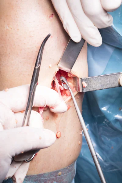 Sebészeti beavatkozás térdműtét — Stock Fotó
