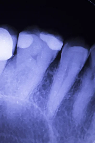 Llenado dental radiografía dental — Foto de Stock