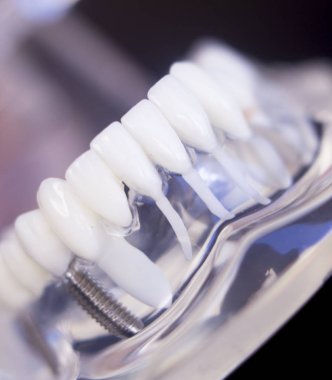 Diş hekimleri diş diş implant