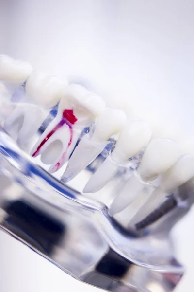 Tandheelkundige tanden wortelkanaalbehandeling — Stockfoto