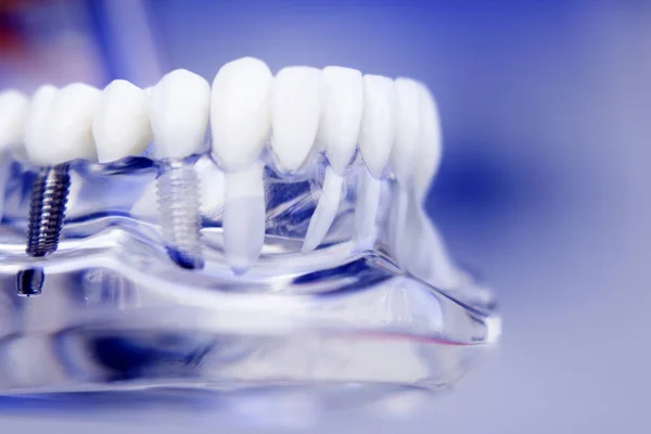 Dentists dental teeth implant — Stock Photo, Image