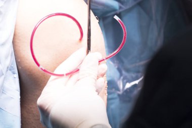 Cerrahi operasyon diz cerrahisi