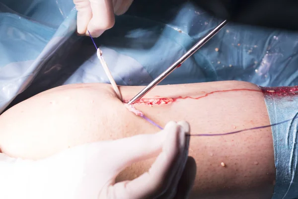 Cirugía quirúrgica Cirugía de rodilla — Foto de Stock