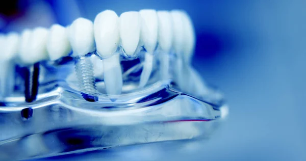 Zubní zuby zubní implantát — Stock fotografie