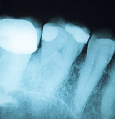 Diş diş xray doldurma