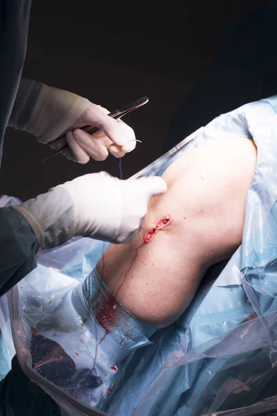 Operação cirúrgica cirurgia do joelho — Fotografia de Stock