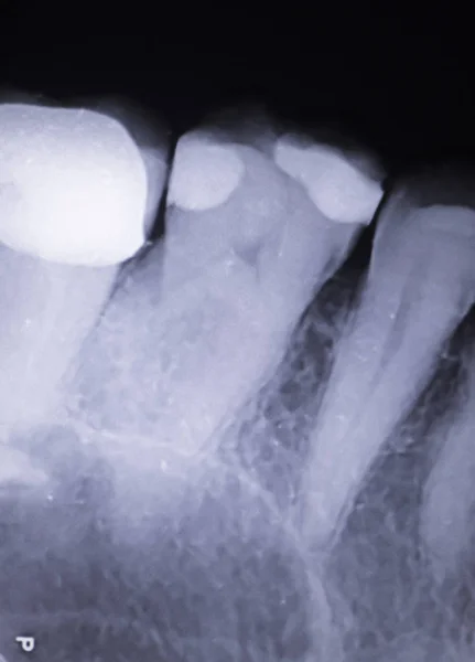 Tooth filling dental xray — Stock Photo, Image