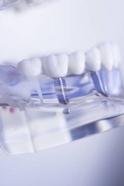 Diş hekimleri diş diş implant