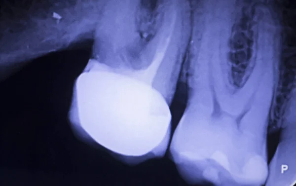 Zahnfüllungen Röntgen — Stockfoto