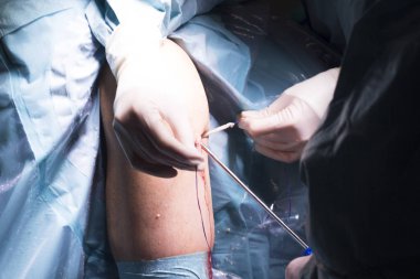 Cerrahi operasyon diz cerrahisi