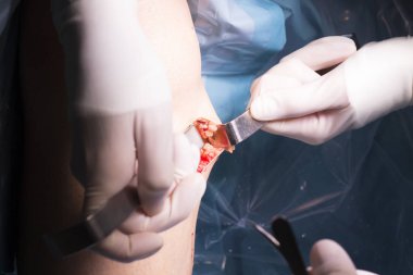 Cerrahi operasyon diz cerrahisi