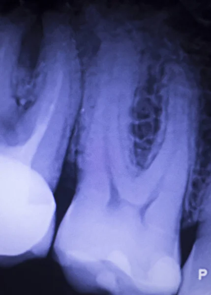 Diş diş xray doldurma — Stok fotoğraf