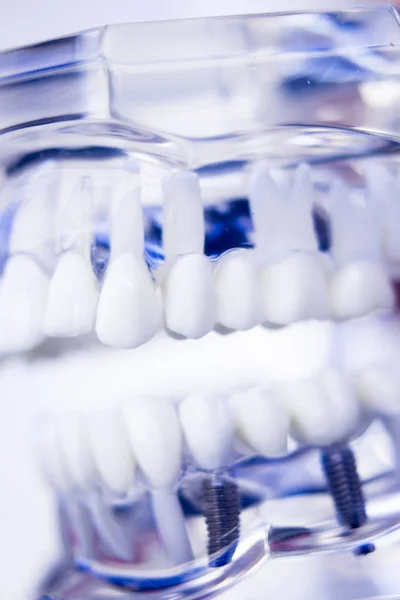 Dentisti impianto dentale dei denti — Foto Stock