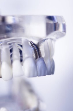 Diş hekimleri diş diş modeli