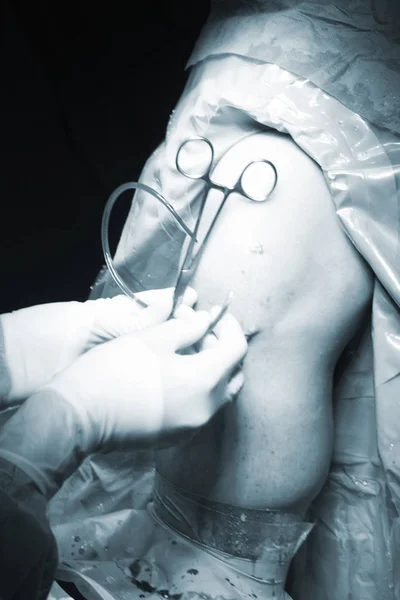Chirurgische ingreep knie-operatie — Stockfoto