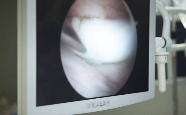 Schermo operatorio di chirurgia del ginocchio — Foto Stock