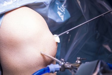 Cerrahi operasyon diz cerrahisi