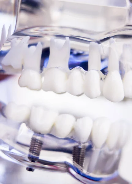 Dentistas implante dental de dientes — Foto de Stock