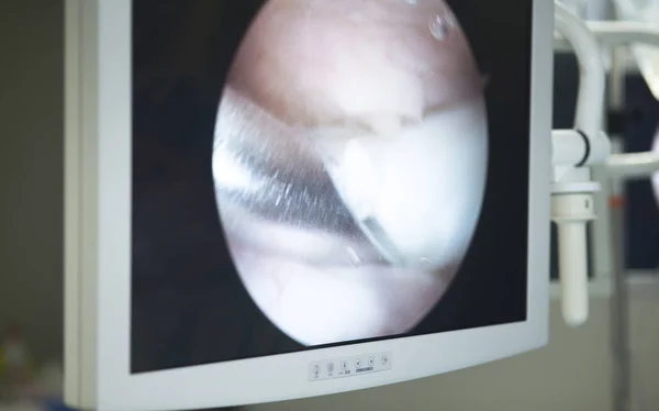 Knee surgery operation screen — Stock Photo, Image