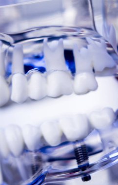 Diş hekimleri diş diş implant