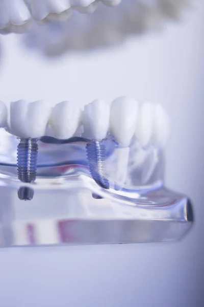 Implant dentystyczny zęby Stomatolodzy — Zdjęcie stockowe