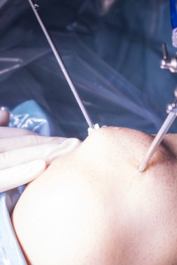 Cerrahi operasyon diz cerrahisi